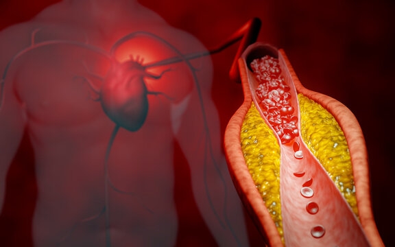Cholesterol in Women